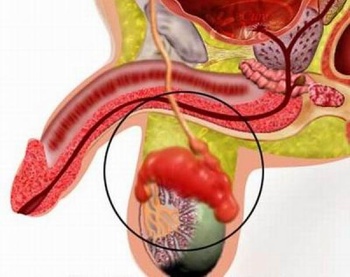 Фото: операция кисты придатка яичка