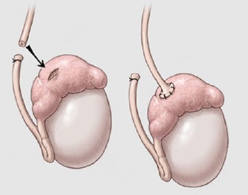 Фото: киста придатка яичка у мужчин
