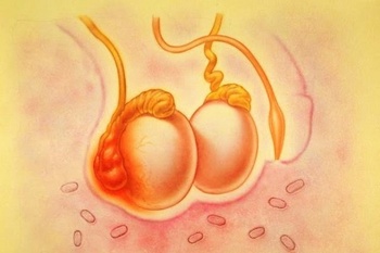 Фото:  киста придатка яичка лечение
